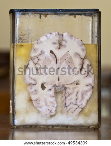 A very old section of a human brain preserved in formaldehyde in a sealed glass container. The vintage piece was recently discovered in an abandoned mental hospital.