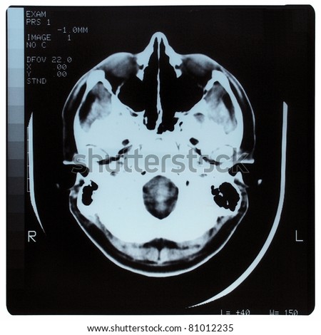 Medical X ray imaging of human brain skull bones