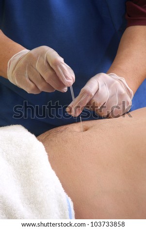 Acupuncture / Hands of a man placing acupuncture needles on a man\'s stomach.