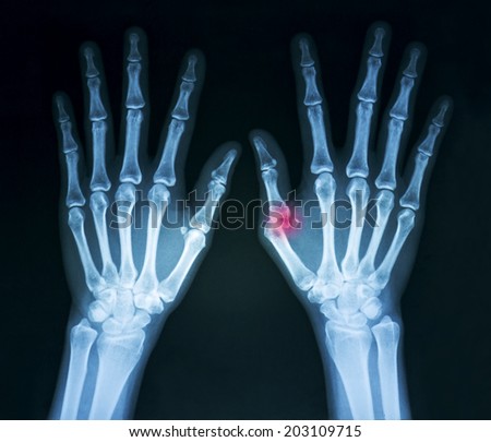 Film x-ray both human\'s hands and thumb crash injury