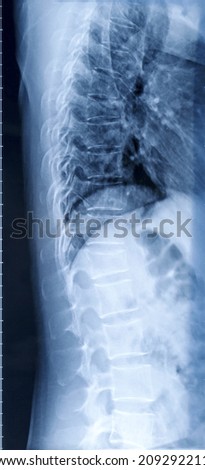 Film x-ray human\'s chest and spine in side view