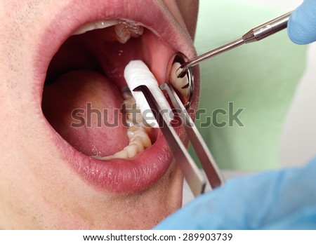 The dentist inserts swab into patient\'s mouth