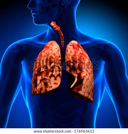 Lung Cancer - Unhealthy lungs