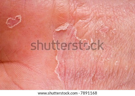 Eczema On Male Hand With Skin Peeling Stock Photo 7891168 : Shutterstock