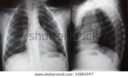 Face And Lateral Projection Of Chest X-Ray Stock Photo 14883997 ...