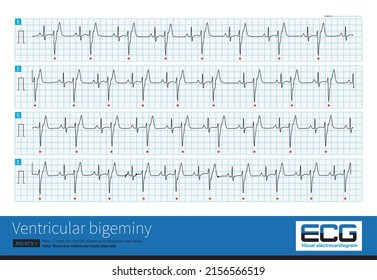 A 17 Year Old Male Was Clinically Diagnosed As Ventricular Septal Defect And His ECG Was Ventricular Bigeminy.Sinus And Ventricular Beats Alternated.