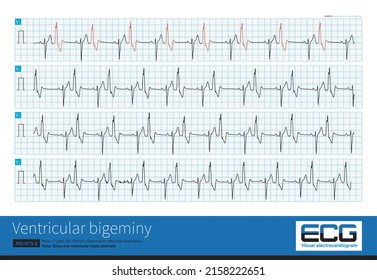 A 17 Year Old Male Was Clinically Diagnosed As Ventricular Septal Defect And His ECG Was Ventricular Bigeminy.Sinus And Ventricular Beats Alternated.This Is A Long V1 Lead.