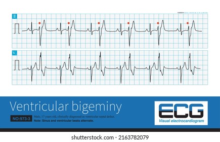 A 17 Year Old Male Was Clinically Diagnosed As Ventricular Septal Defect And His ECG Was Ventricular Bigeminy.Ventricular Premature Contraction Originated In The Left Posterior Fascicular Region.