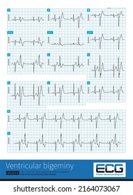 A 17 Year Old Male Was Clinically Diagnosed As Ventricular Septal Defect And His ECG Was Ventricular Bigeminy.Ventricular Premature Contraction Originated In The Left Posterior Fascicular Region.