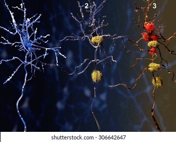 3 phases of the Alzheimer disease.
1. Healthy neuron. 2. Neuron with amyloid plaques (yellow). 3. Dead neuron being digested by microglia cells (red) 