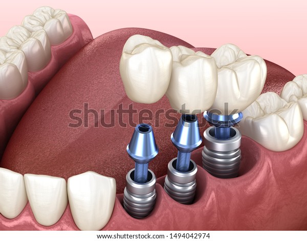 3 tooth crowns placement over\
3 implants - concept. 3D illustration of human teeth and\
dentures