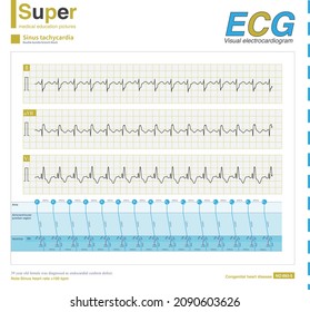 A 39 Year Old Female Was Diagnosed As Endocardial Cushion Defect. ECG Showed Sinus Tachycardia, Complete Right Bundle Branch Block Combined With Left Anterior Fascicular Block.