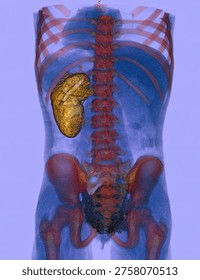 3D abdominal CT reconstruction demonstrating unilateral renal agenesis with absence of one kidney and compensatory contralateral renal anatomy, relevant for congenital urogenital anomaly evaluation.