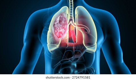 3D Anatomical Visualization of Human Lungs with Malignant Bronchial Carcinoma. lung cancer. 3d illustration	