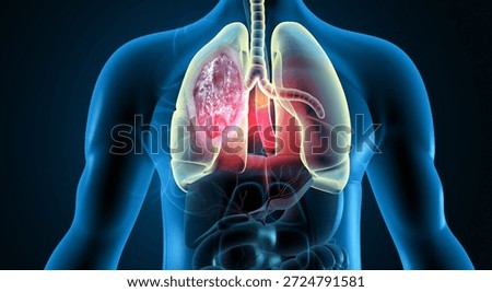 3D Anatomical Visualization of Human Lungs with Malignant Bronchial Carcinoma. lung cancer. 3d illustration	