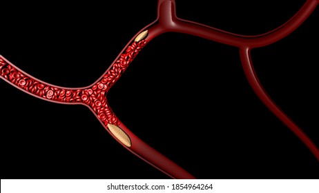 3d clot thrombus for medical health on black 3d render