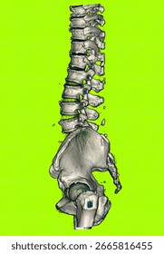 3D CT Scan Reconstruction of Human Lumbar Spine and Pelvis with Color Mapping