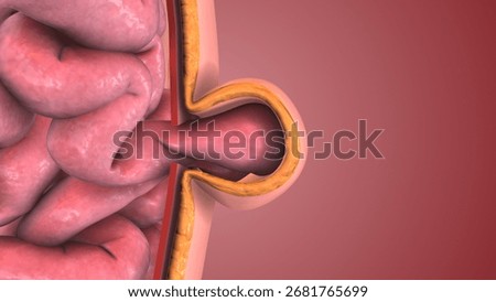 3D illustration of Abdominal Hernia Development