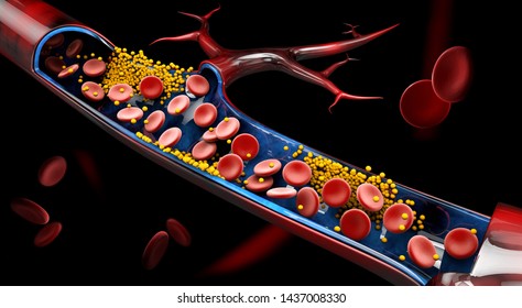 3d Illustration of blood cells with plaque buildup of cholesterol.