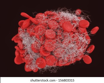 3d illustration of a blood clot, thrombus or embolus with coagulated red and white blood cells, platelets and clotting factors trapped in an insoluble fibrin network in the blood vessels of the body