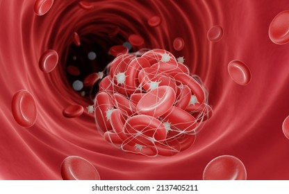 3d Illustration Of A Blood Clot (Thrombus), Blood Clots Can Block Veins Or Arteries And Cause Thrombosis, Complication Of Thrombosis Include Stroke And Heart Attack