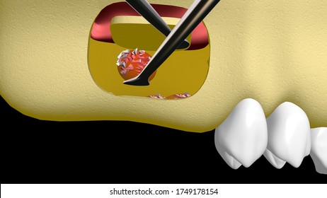 3d Illustration Of Bone Graft