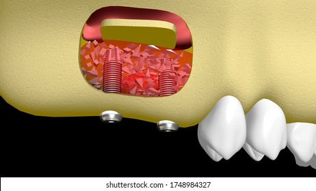 3D Illustration Of Bone Graft In The Maxilla