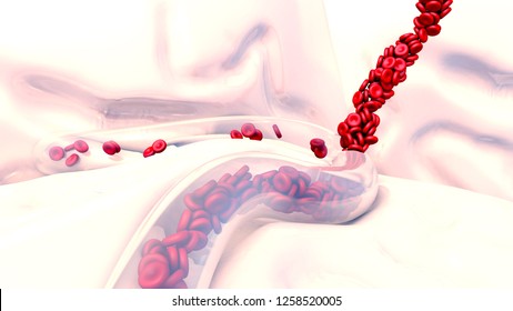 3d Illustration Brain Hemorrhage