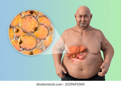 3D illustration of a Caucasian man with transparent skin, revealing a fatty liver, highlighting liver anatomy and fat accumulation, alongside with close-up view of fat cells. - Powered by Shutterstock