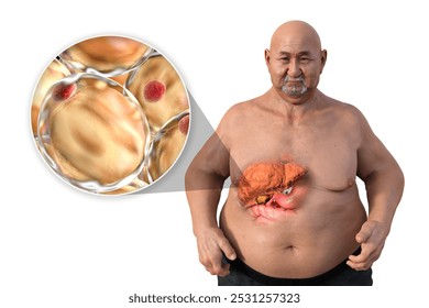 3D illustration of a Caucasian man with transparent skin, revealing a fatty liver, highlighting liver anatomy and fat accumulation, alongside with close-up view of fat cells. - Powered by Shutterstock