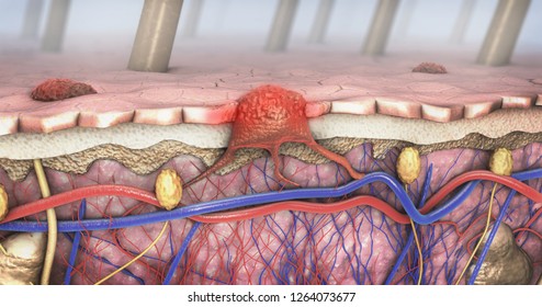 3d Illustration Of A Cross-section Of A Diseased Skin With Melanoma That Enters The Bloodstream And Lymphatic Tract