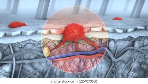 3d Illustration Of A Cross-section Of A Diseased Skin With Melanoma That Enters The Bloodstream And Lymphatic Tract