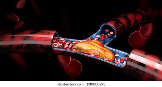 3d Illustration of Deep Vein Thrombosis or Blood Clots, Embolism.