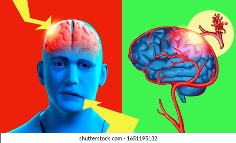 3d Illustration. Facial Asymmetry Is A Symptom Of Ischemic Stroke. Bright Color Stroke Concept Poster.