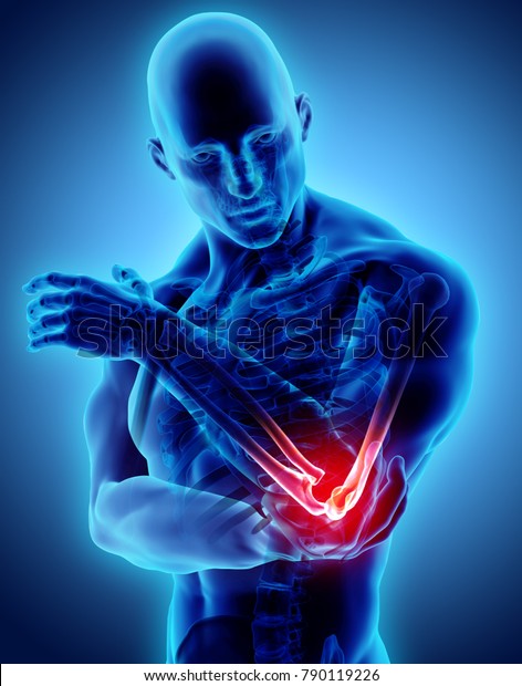 人間の肘のけがの3dイラスト 医療コンセプト のイラスト素材