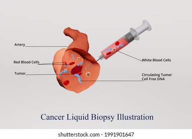 3d Illustration Liquid Biopsy Procedure Cancer Stock Illustration ...