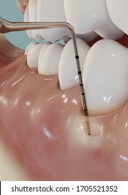 3D illustration of periodontal probing