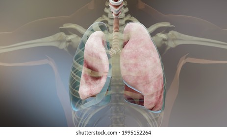 1,068 Pneumothorax Images, Stock Photos & Vectors | Shutterstock