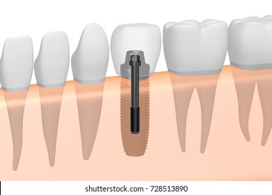3D illustration/ 3D rendering - dental implant/ tooth implant.