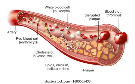 3D illustration showing artery with white and red blood cells, cholesterol, lipds, calcium and disrupted plaque with thrombus