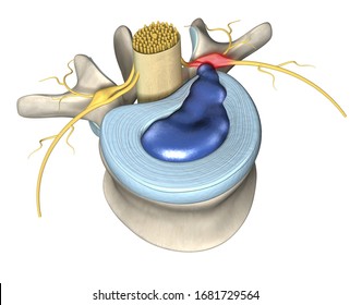 3D illustration showing painful herniated disc, or slipped disc