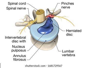 3D illustration showing painful herniated disc or slipped disc