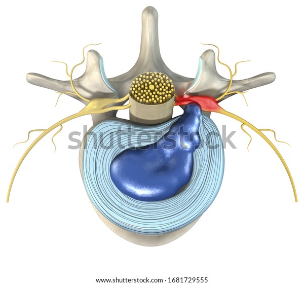 3d Illustration Showing Painful Herniated Disc Stock Illustration 1681729555