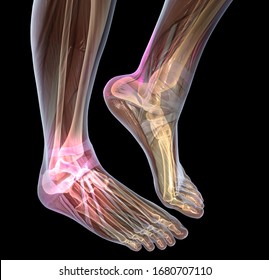 3D illustration showing painful osteoarthritic ankle joint, 3D illustration