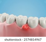 3d illustration of Swollen gums, Teeth with gum inflammation or Gum disease.