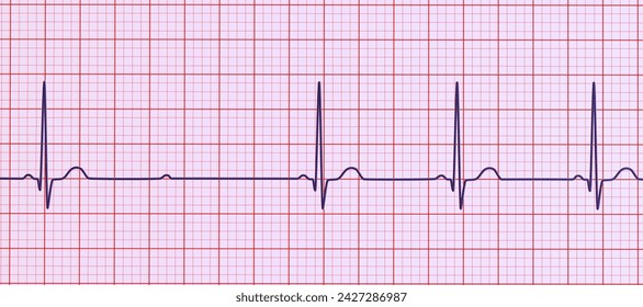 3D illustration visualizing an ECG with 2nd degree AV block (Mobitz 2), highlighting abnormal electrical conduction in the heart rhythm. - Powered by Shutterstock