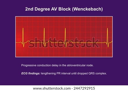 3D illustration visualizing an ECG of 2nd degree AV block (Wenckebach), highlighting abnormal electrical conduction in the heart rhythm.