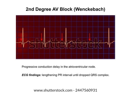 3D illustration visualizing an ECG of 2nd degree AV block (Wenckebach), highlighting abnormal electrical conduction in the heart rhythm.