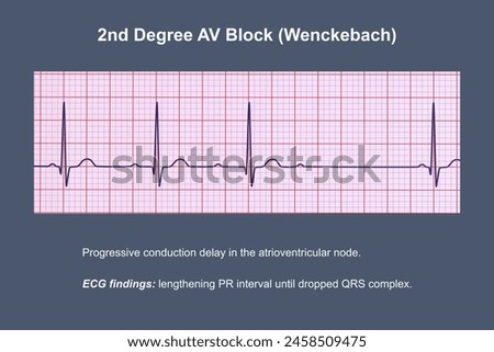 3D illustration visualizing an ECG of 2nd degree AV block (Wenckebach), highlighting abnormal electrical conduction in the heart rhythm.