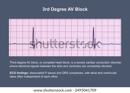 3D illustration visualizing an ECG with 3rd degree AV block, showing complete dissociation between atrial and ventricular rhythms.